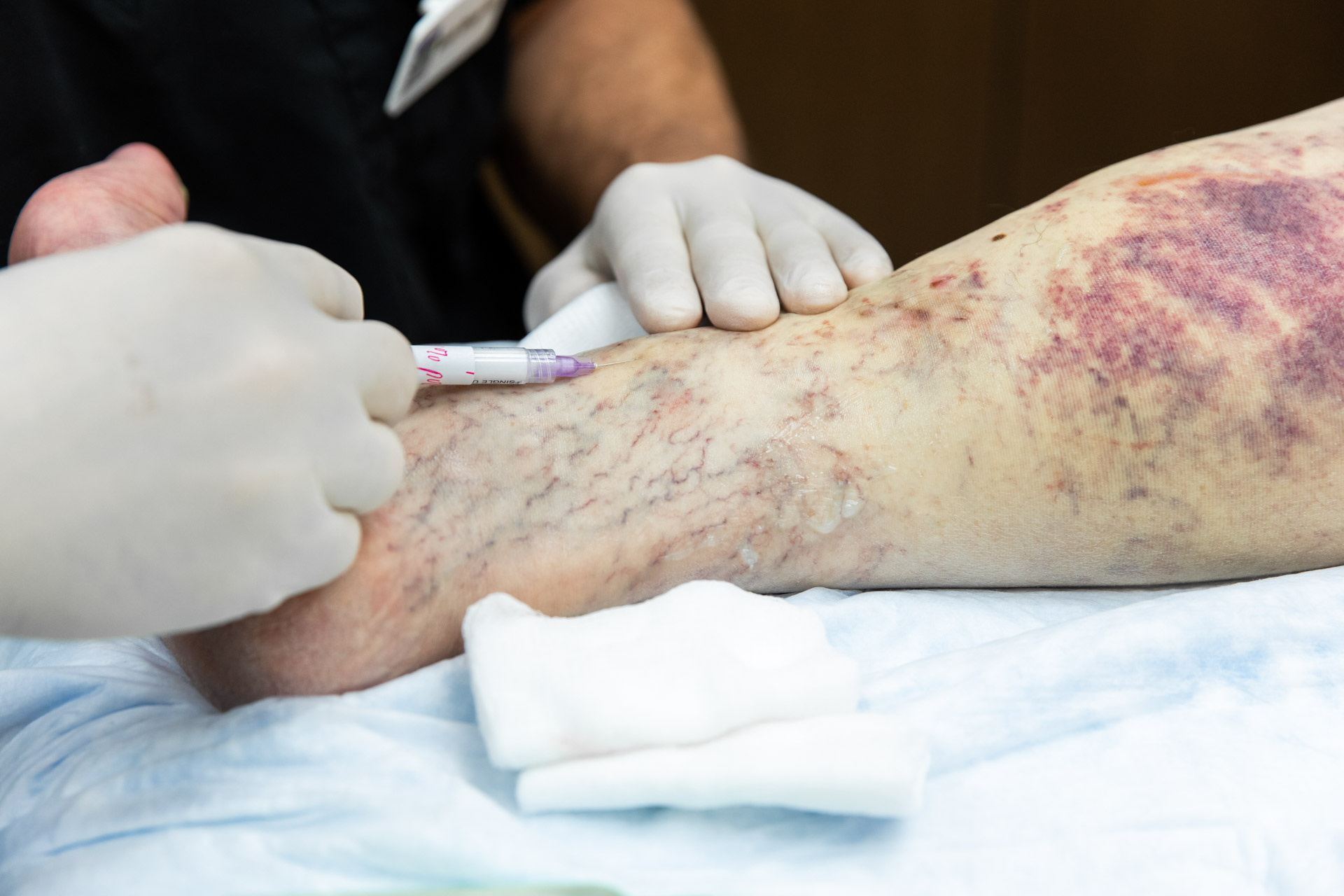 A doctor injects a leg for substantial Sclerotherapy before & after results