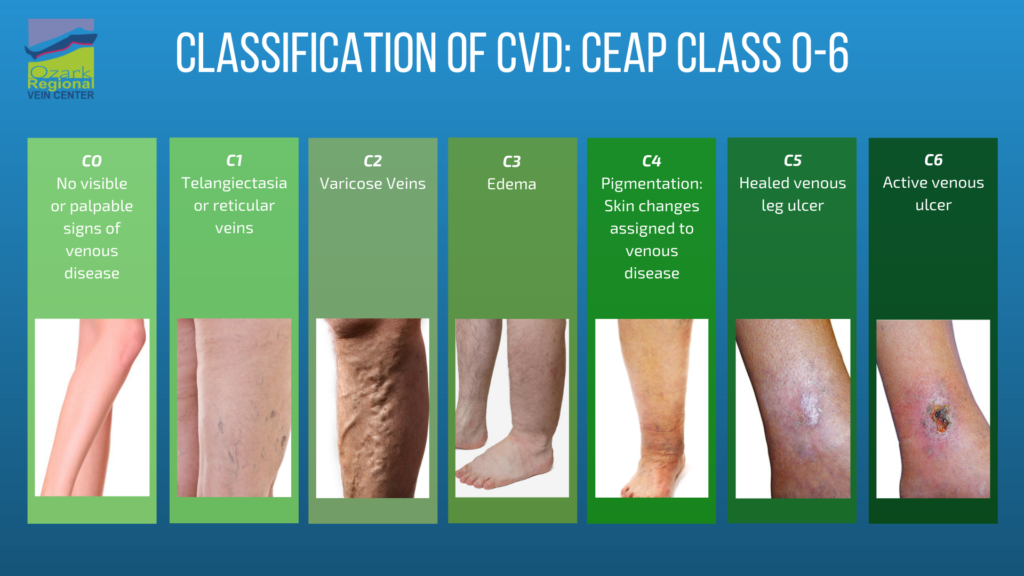 Explaining Ceap Classifications For Vein Treatment In Arkansas Ozark