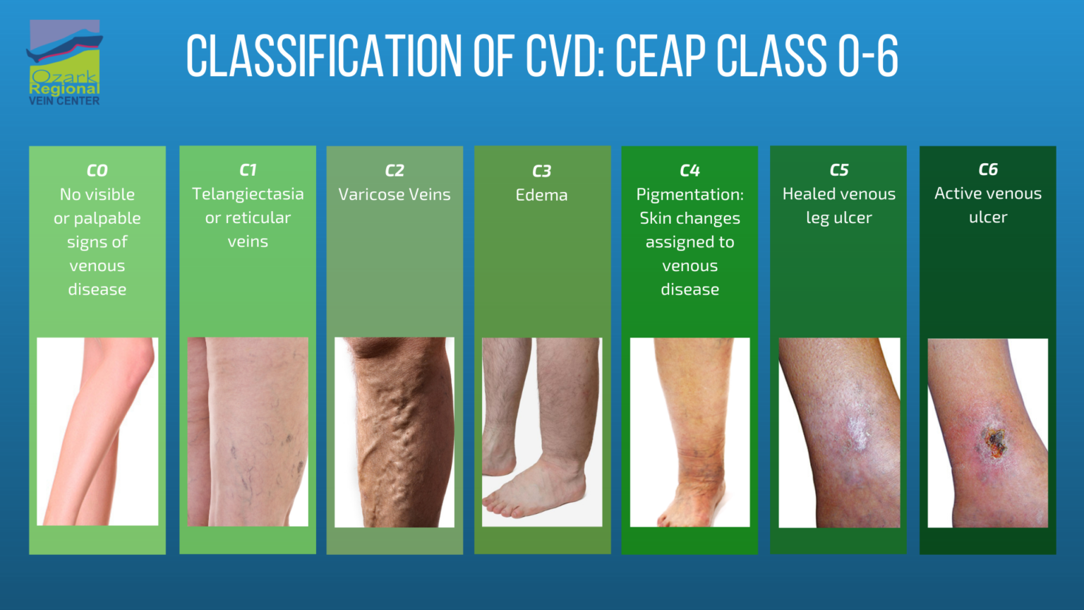 Explaining CEAP Classifications For Vein Treatment In Arkansas Ozark   Classification Of CVD  CEAP Class 0 6 ORVC TV 1536x864 